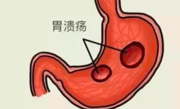 胃潰瘍的食療方法