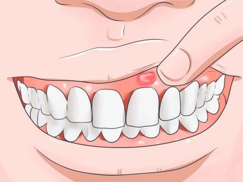 牙齦腫痛怎麼辦