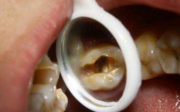 牙髓炎吃什麼藥