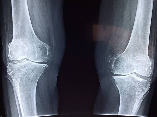 膝蓋酸軟是怎麼回事