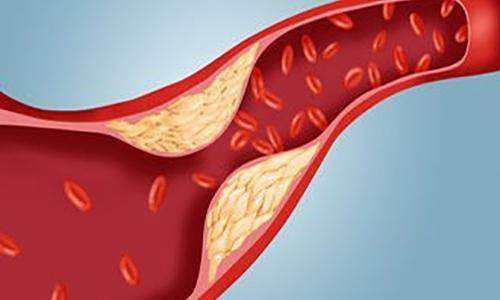 血管硬化的原因癥狀及危害