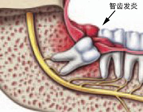 牙齦腫痛怎麼辦