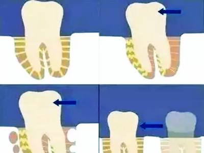 牙齒松動可以恢復嗎