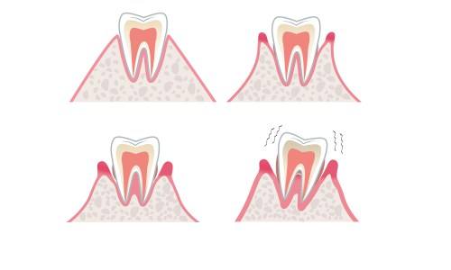 牙齒松動的原因