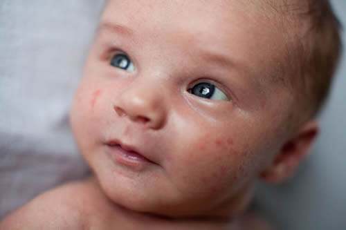 寶寶臉上長濕疹怎麼辦