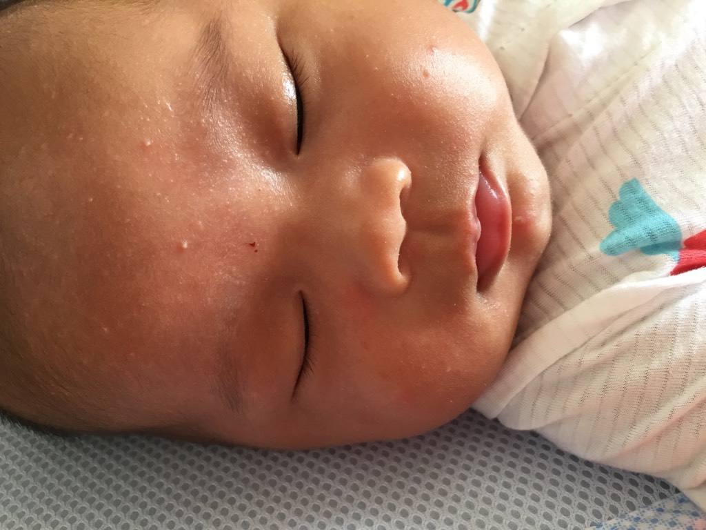 寶寶臉上長濕疹的危害