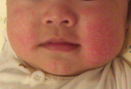 寶寶臉上長濕疹是什麼原因