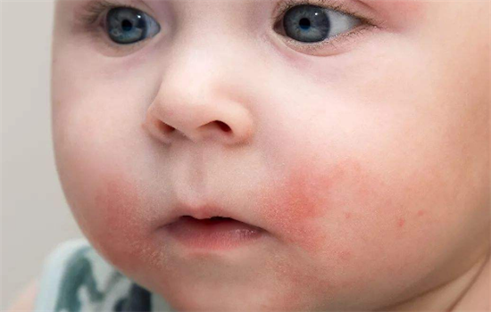 孩子皮膚過敏會出現的癥狀