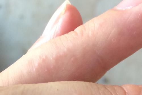 手上長小水泡是濕疹嗎