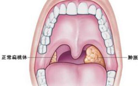 扁桃體發炎是怎麼引起的
