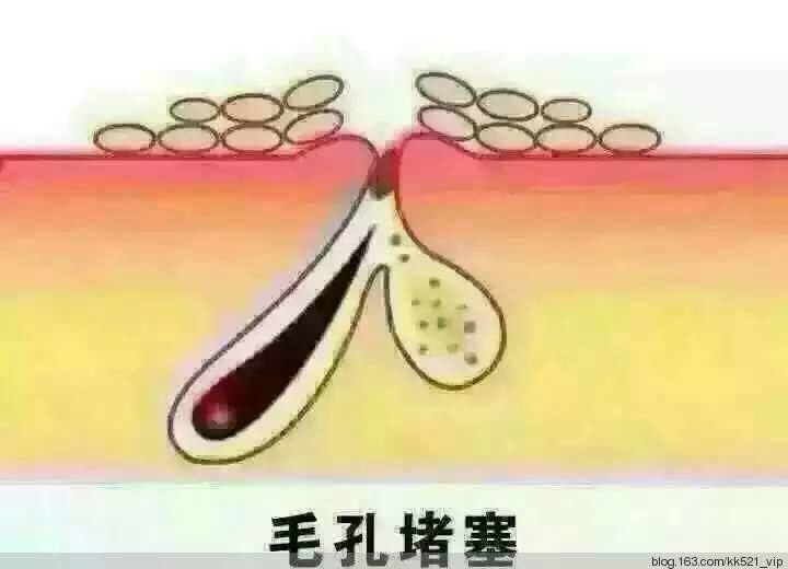 毛孔堵塞的癥狀