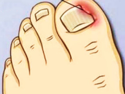 腳指甲往肉裡長的原因及危害
