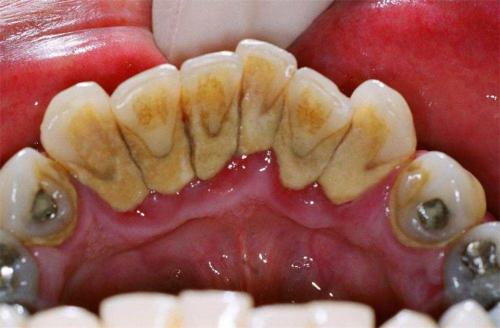 導致大傢出現牙齒出血的因素
