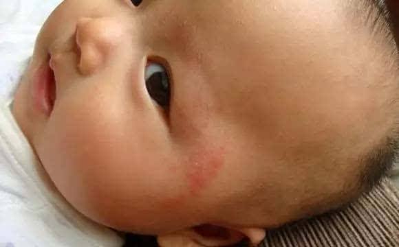 寶寶濕疹註意事項