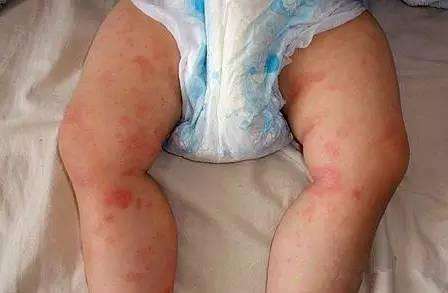 寶寶濕疹能自愈嗎