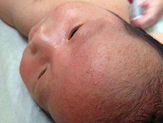 寶寶痱子和濕疹的區別