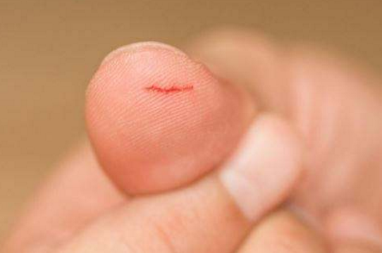 常見的外傷出血應該如何處理