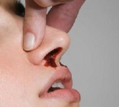 流鼻血的正確急救方法