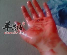 介紹一些生活中止血的方法