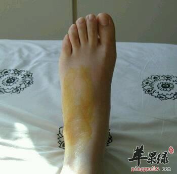 腳部扭傷瞭以後如何護理