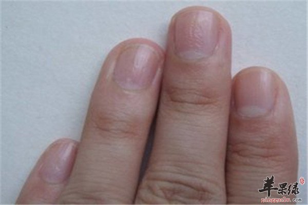 治療灰指甲的四個小偏方
