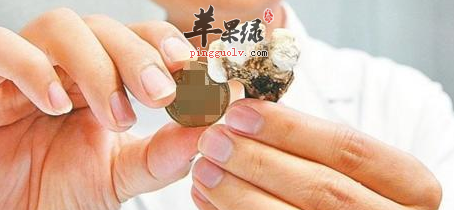 腎結石患者的飲食原則介紹