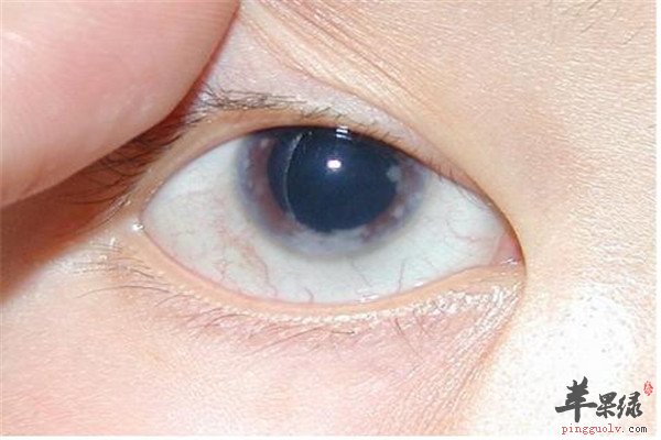 青光眼的保健預防方法