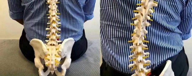 脊柱關節炎的早期癥狀 脊柱關節炎是什麼