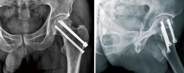 股骨頸骨折內固定術以後會壞死嗎 愈合率高嗎