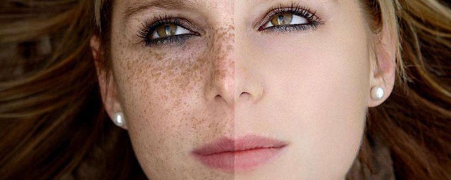 臉上兩側長斑原因是什麼 臉上兩側為什麼會長斑