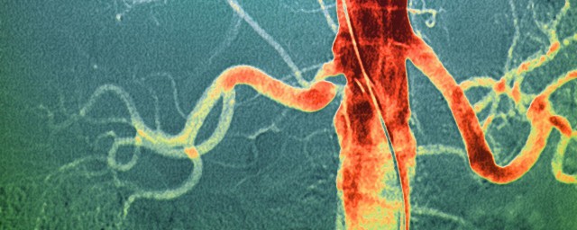 主動脈硬化需要治療嗎 主動脈硬化怎麼治