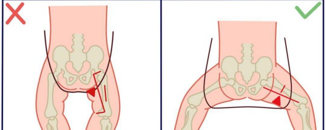 小孩5歲多有些羅圈怎麼辦 羅圈腿怎麼矯正