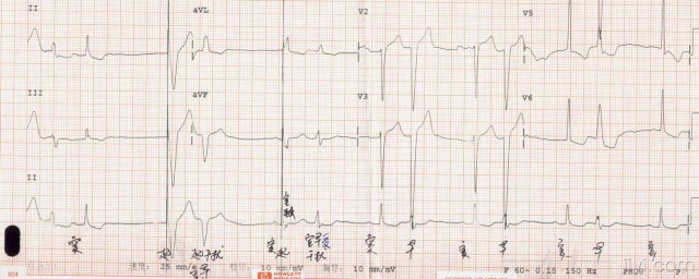 心電圖檢查梯波低是怎麼回事 5大狀態