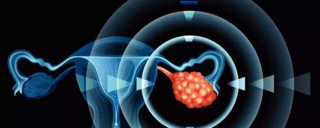 液漿卵巢癌如何鑒別 什麼癥狀