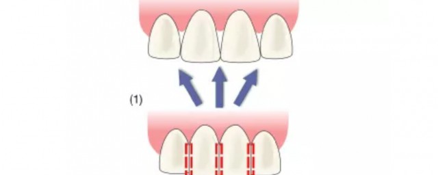 牙齒黑三角如何修復 牙齒為什麼會黑三角
