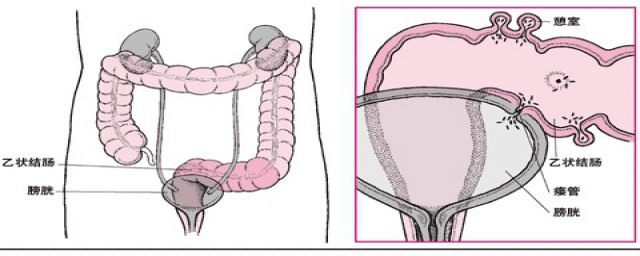 十二指降腸憩室的位置 主要介紹其生理位置
