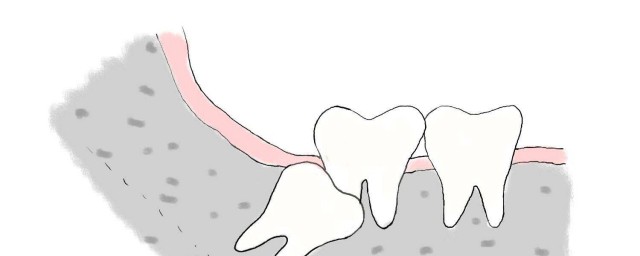 橫生智齒和阻生智齒的區別 兩者有什麼不同