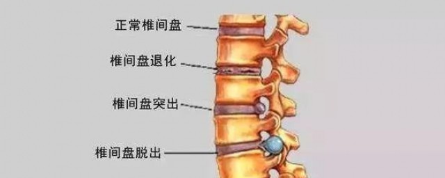腰椎反弓怎麼恢復 學會這幾點