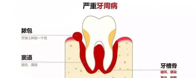 牙齦膿包能自愈嗎 應該如何治療