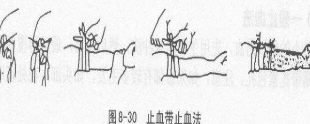 絞棒止血法的要訣是什麼 還有其他辦法嗎