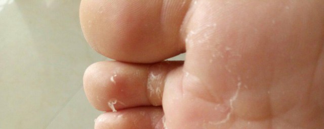 腳指頭脫皮嚴重怎麼回事 腳指頭脫皮嚴重的原因