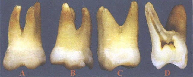 牙本質暴露怎麼修復 什麼叫牙本質暴露