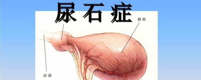 藥物溶石後會復發麼 結石怎麼治療