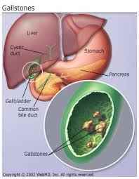 gallstone