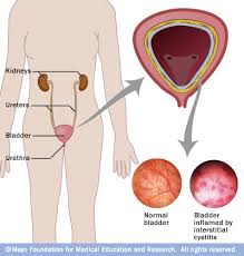 cystitis