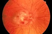 retinitis