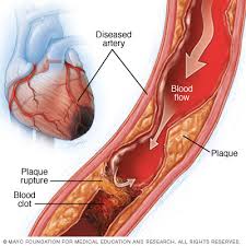 ischemia