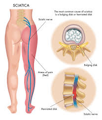 sciatic