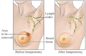 lumpectomy