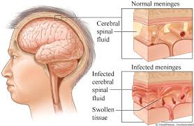 meningitis